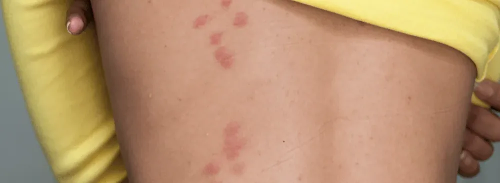 Bed bug bites lined up on a person’s back