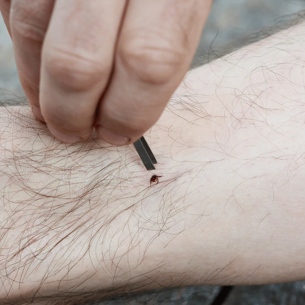 Tick bite