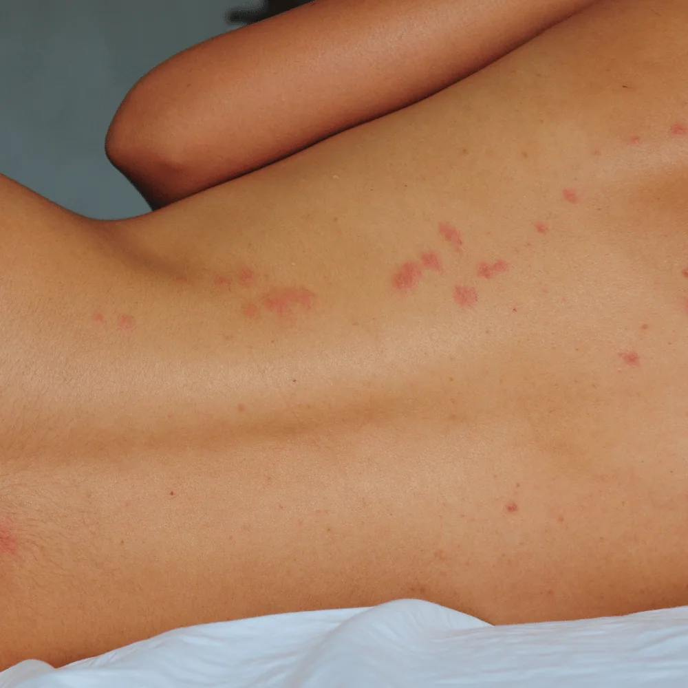 Bed bug bites