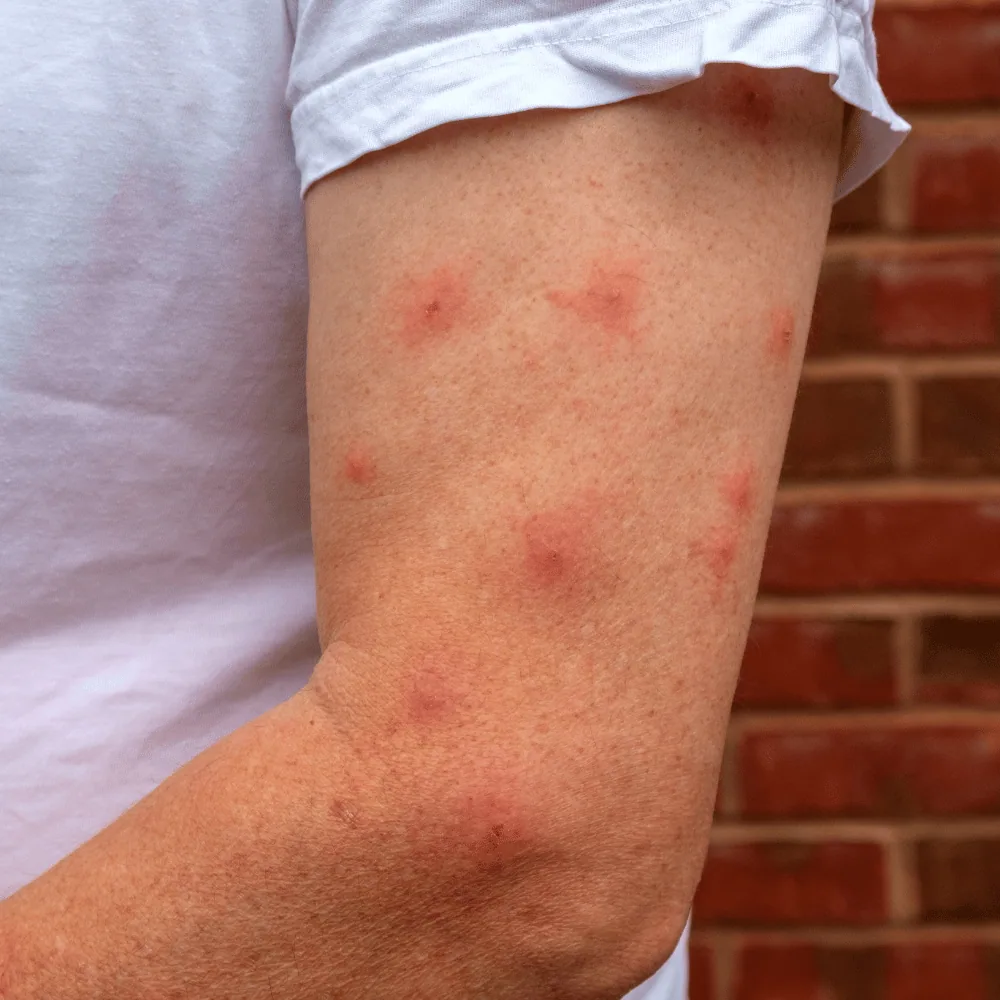 Mosquito bites